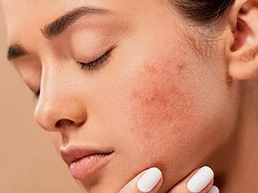 acne&pimple